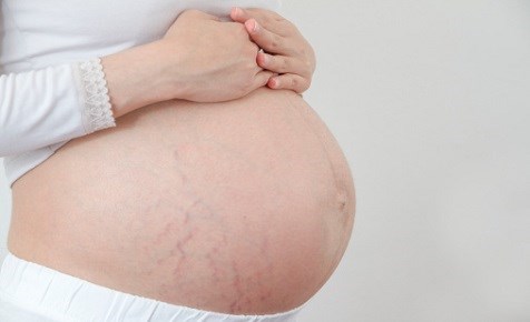 Cách sử dụng vitamin E xóa rạn da tại nhà Cách sử dụng vitamin E xóa rạn da tại nhà